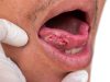 Penyebabkan Kanker Rongga Mulut! Berikut Penjelasan Lengkap Dokter
