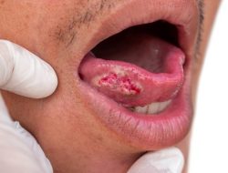 Penyebabkan Kanker Rongga Mulut! Berikut Penjelasan Lengkap Dokter