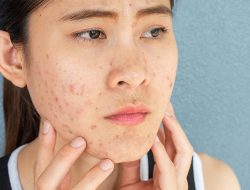 Gak Pede Punya Acne Prone Skin? Ini Cara Perawatan Tepat untuk Mengatasinya
