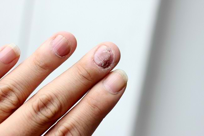 Recognize the signs of cancer from nail changes: What you should be aware of